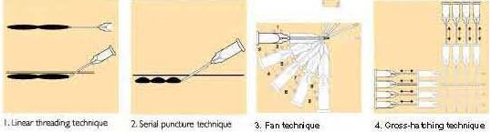 hyaluronic-acid-injection-technique